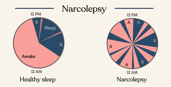 Narcolepsy sleep disorder improves carnitine daytime apnea difference between alertness